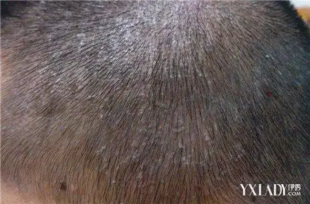 头皮干燥大块头屑是怎么回事7大临床因素告诉患者