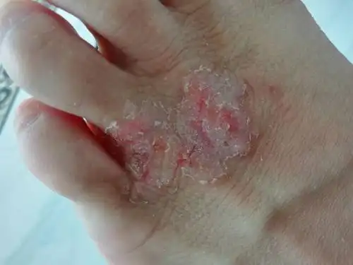 皮肤科医生帮我看看这是什么癣