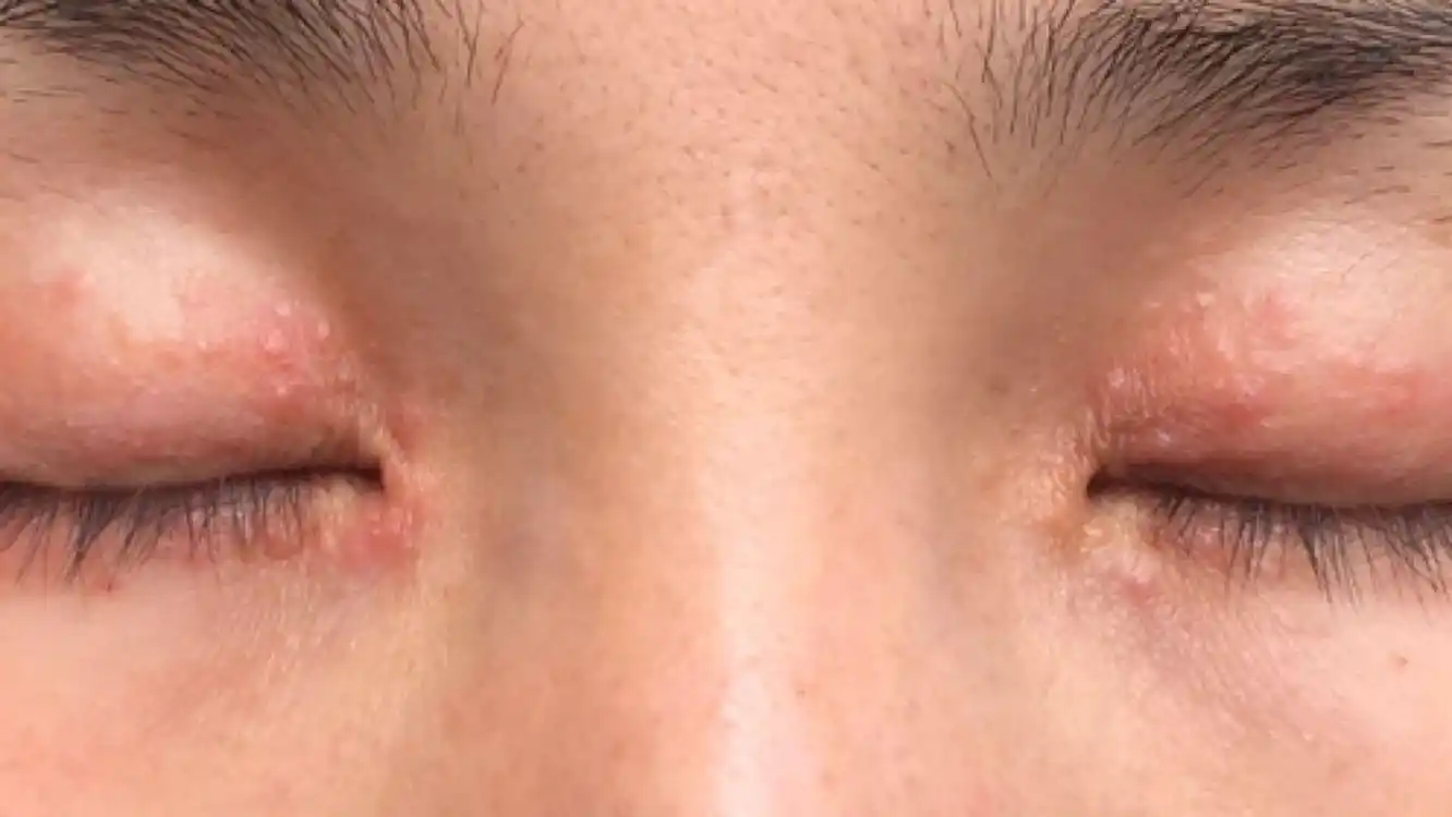 眼睛周围起了很多红疙瘩,红痒肿怎么办?