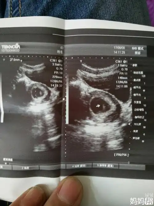 幸运!胎心不规则"郁郁葱葱"-第1张图片-蒲城博客