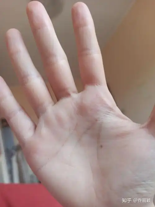 掌心痣? - 知乎