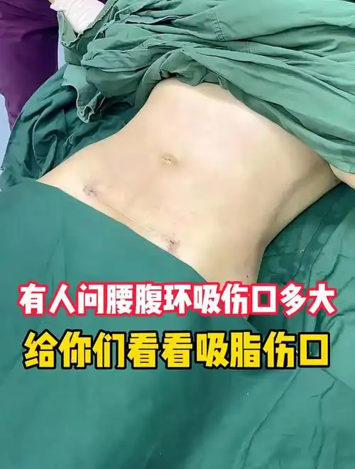 有人问腰腹环吸伤口多大给你们看看吸脂伤口