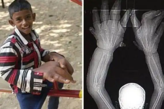 世界上最大的手指食指长度高达30厘米