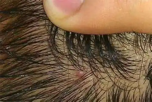 头皮里面为什么会长痘痘可能与4个原因有关不妨了解下