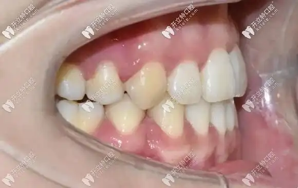 矫正后的牙齿侧面效果图