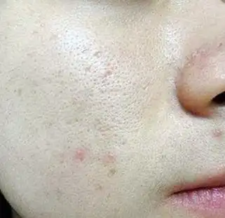 毛孔粗大可分为四种类型:角质型,油光型,缺水型,老化型.