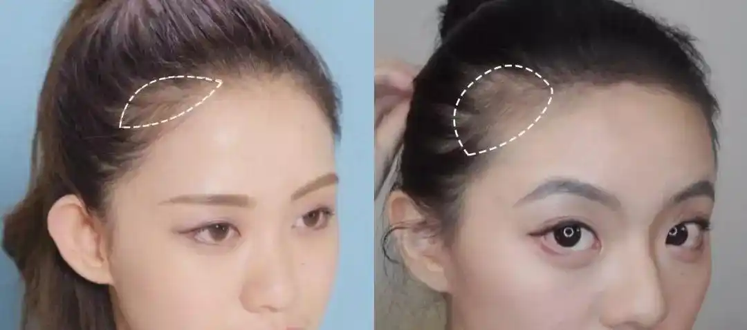 方 法 一 不少宝宝都是方形发际线,两侧额角秃秃的空白一块,包括瑞拉