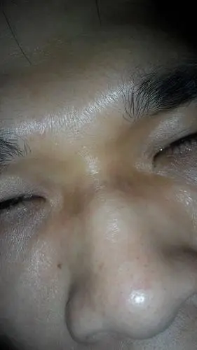 鼻梁上有一路过去都是黑的里面有些小黑快请问怎么才能清掉