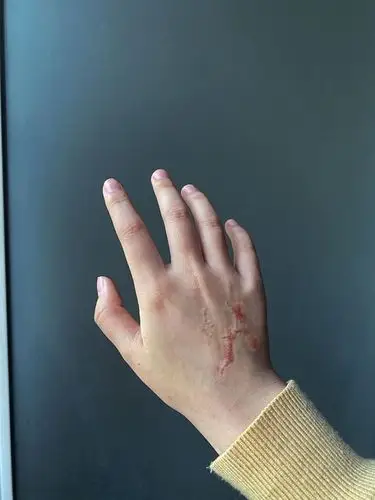 手上因烫伤留下的疤痕,在恢复期出现了增生,以至于现_圈子-新氧美容