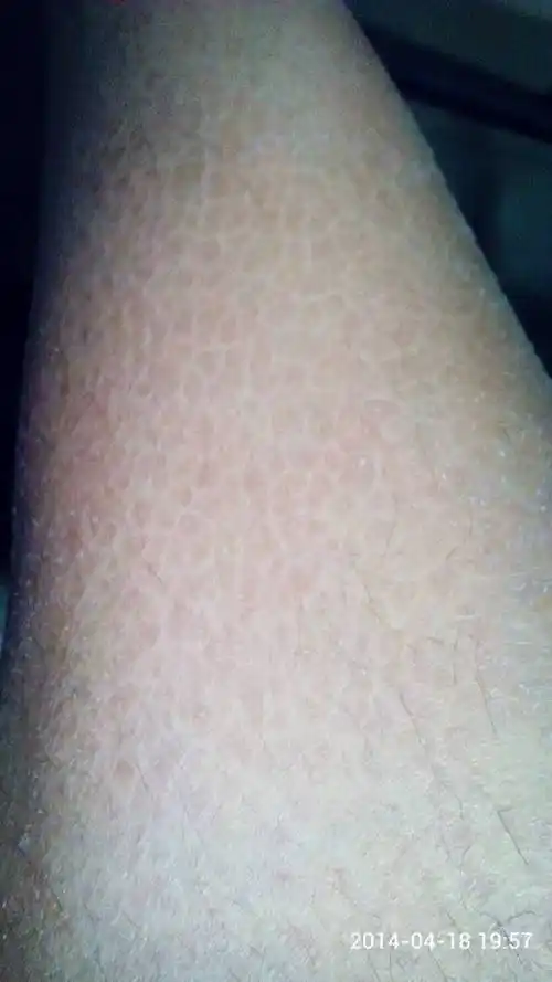 我腿上总是有很多死皮,皮肤也很粗糙,这是怎么回事