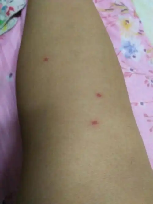 虾裹粉出现红点是过敏吗