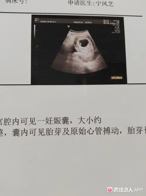 胎芽胎心都有了哦!