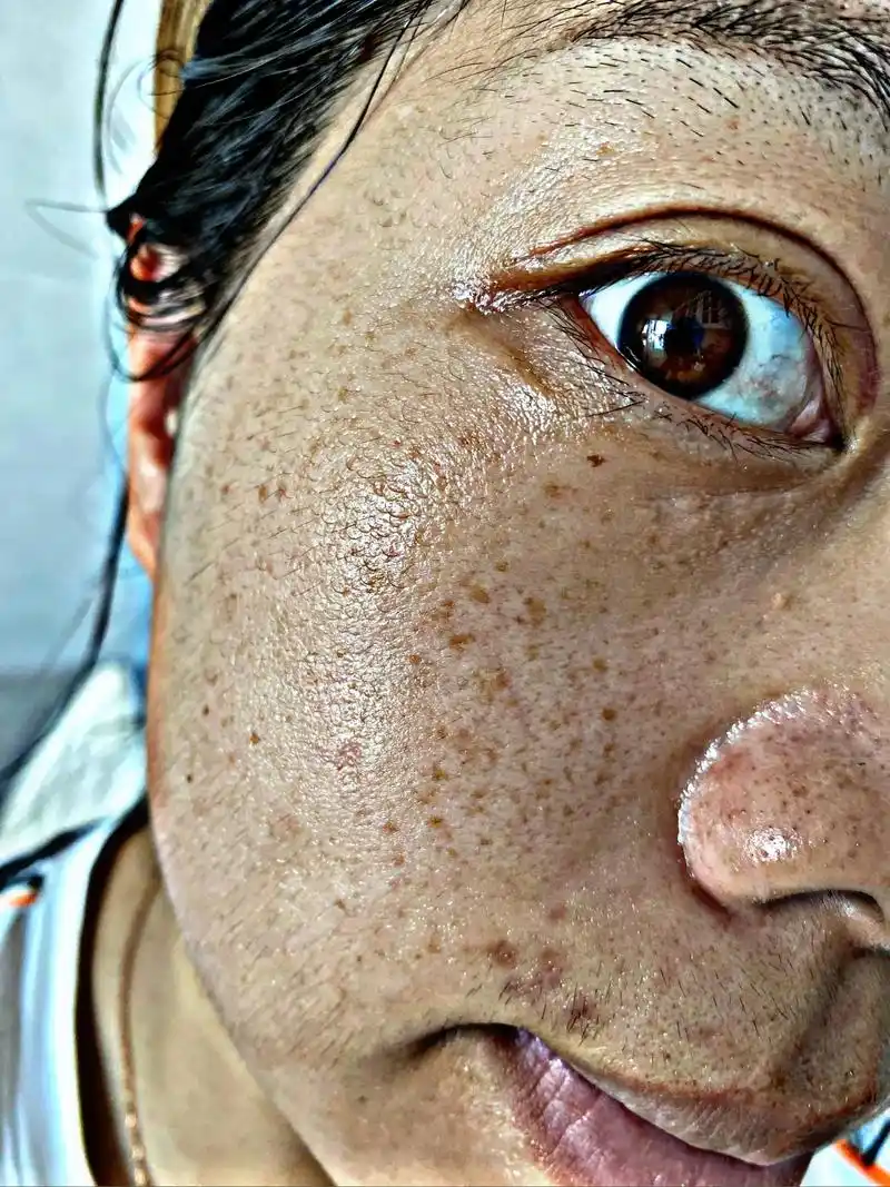 我想这就是我继续坚持下去的原因吧,黑点点没了,皮肤也不黑了# - 抖音