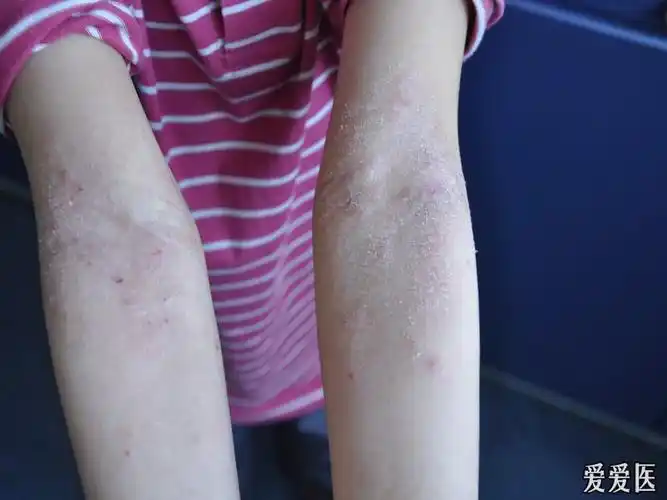 患异位性皮炎(干性)多年,为治疗孩子的病,我也看了不少中医关于湿疹的