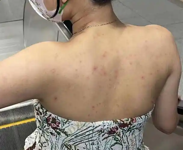 快速祛痘不复发!_皮肤_长痘痘_感觉