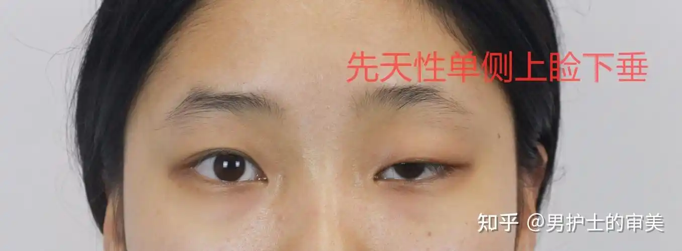 那么,什么是上睑下垂呢?