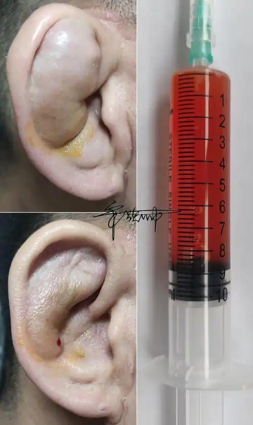 典型病例:耳廓假性囊肿_耳廓假囊肿_介绍_治疗方式 - 好大夫在线