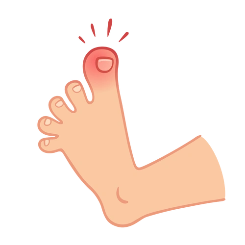 甲沟炎|软组织|脚趾头|指甲|嵌甲|-健康界