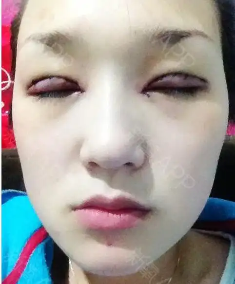 双眼皮 开眼角术后