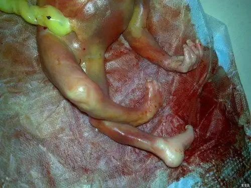 脑积水,脊柱裂引产后图片