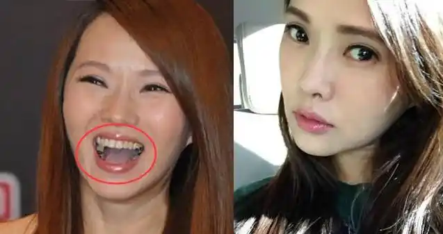 明星牙齿矫正,虫牙,明星牙齿,牙科网www.yadashi.com