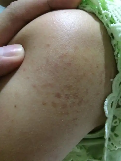 这是什么,长的暗疮么,好吓人,今天才看到,就肩膀两边才有