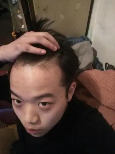 头发两侧掉发,发际线已经退后了不少了额头前部也开始变的稀少,怎么办