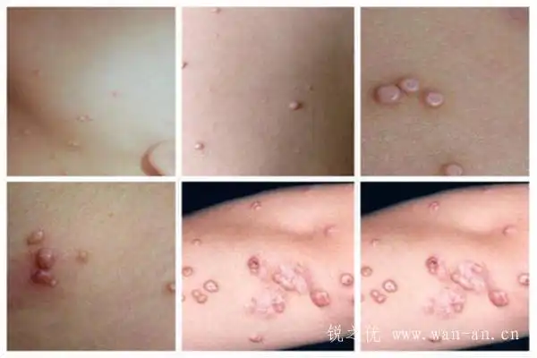 什么药膏能让疣体脱落不反复(选择:锐之优除疣液)