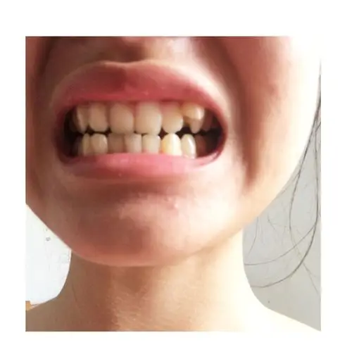 顶上的"虎牙"是小时候怕痛不敢摘掉长出的新牙