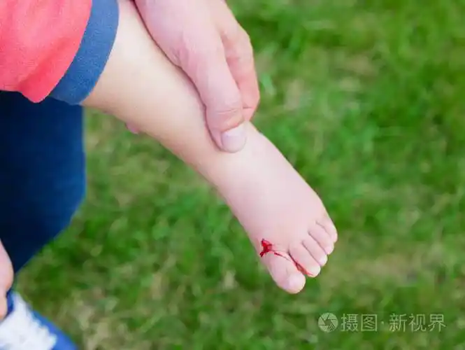 那孩子的腿受伤了.这个女孩为她的孩子提供急救.那女孩伤了腿.