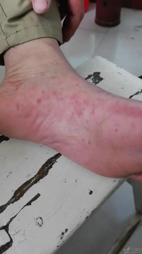【请教】手脚皮疹是病毒性还是过敏性? - 皮肤性病 -丁香园论坛