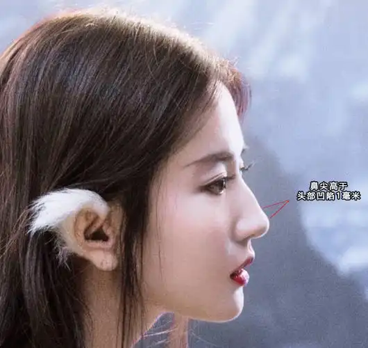 有驼峰鼻的女生如何矫正