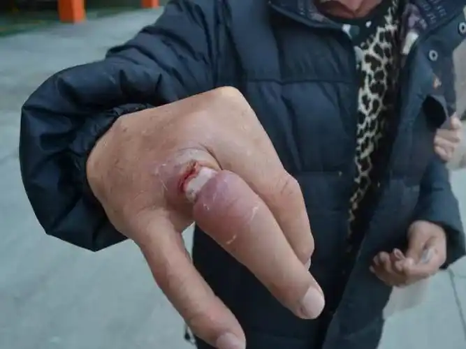 遂宁一男子手指被戒指长时间死死卡住,摘下时已肿变形!