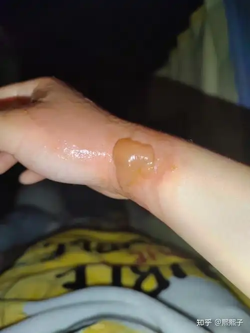 记录一下被烫伤的恢复过程