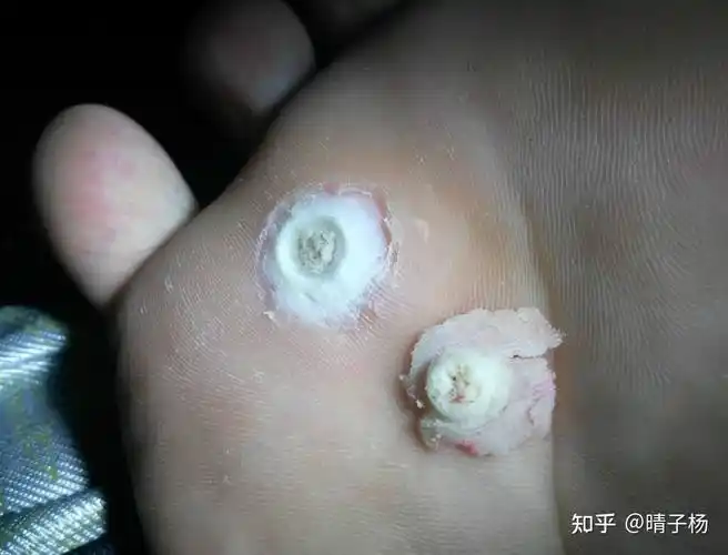 鸡眼怎么彻底挖出