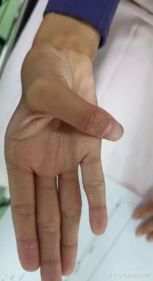 患上小儿马方综合征的病因是什么