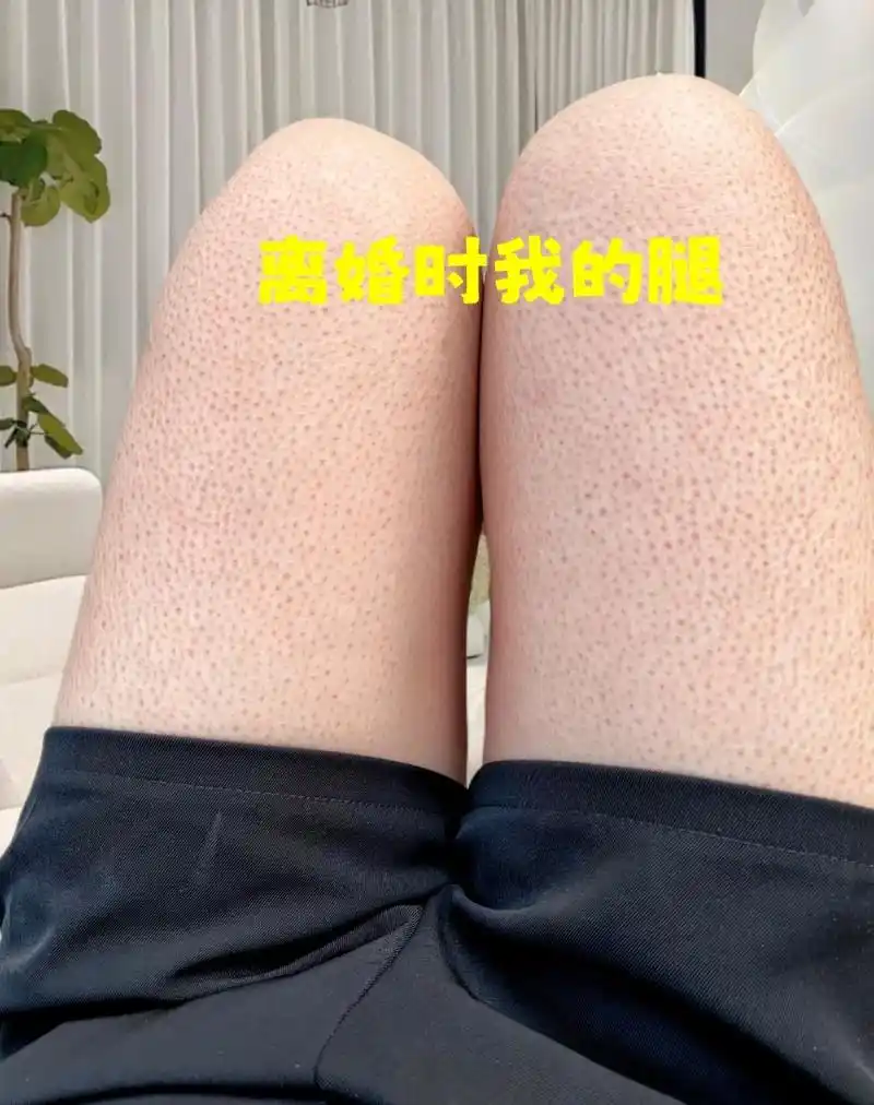 鸡皮肤 多亏了舞蹈生闺蜜告诉我的#尿素霜去鸡皮 小妙招!没 - 抖音