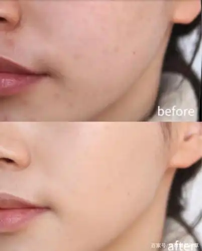 护肤品什么牌子好?有效祛痘印的平价好物排行榜出炉