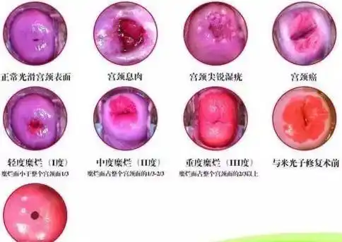 女性可怕的宫颈病变炎症,糜烂,囊肿,息肉,肥大;防大于治呀!