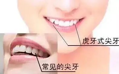 深圳牙科医院科普丨你的虎牙需要做牙齿矫正吗