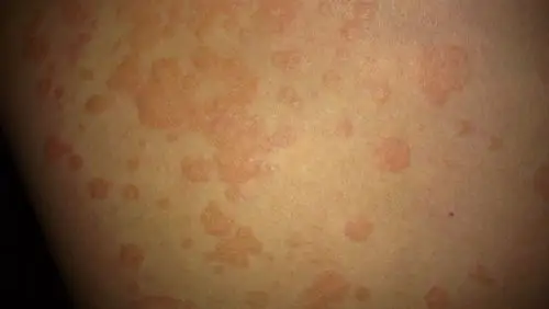 工作一个月后,身上起红斑!请看图片了解细节!