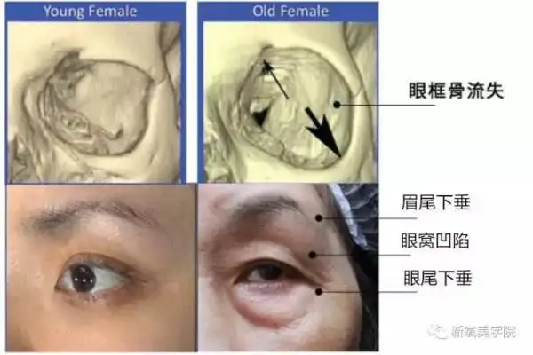 骨骼结构衰老 对于骨骼层面的衰老来说,首先是 骨骼结构会发生改变