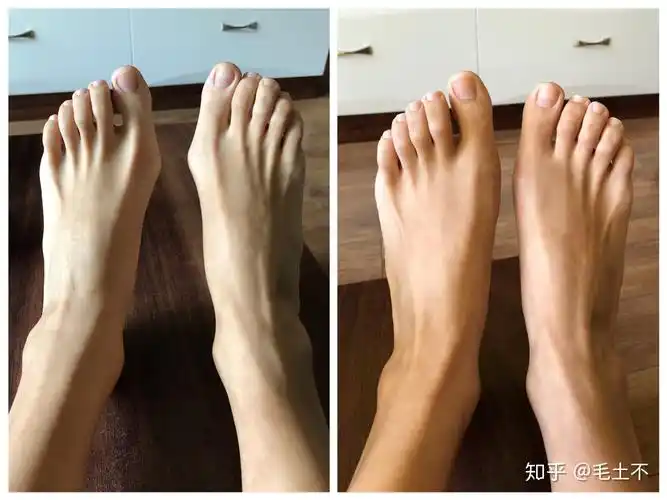 我的拇外翻手术经历七术后四个半月更新多图