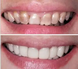 牙齿美白 冷光美白 治疗效果在线咨询