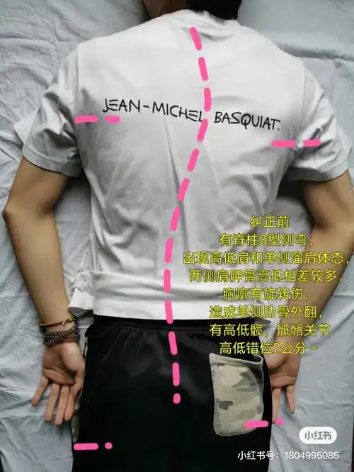 肩胛骨高低相差较多,胸廓有旋转伤,导致出现单侧肋骨外翻～骶髂关节