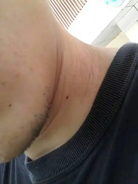 问:一到夏天出汗就脖子侧边就会很痒,然后长出一些类似癣的东西,请问