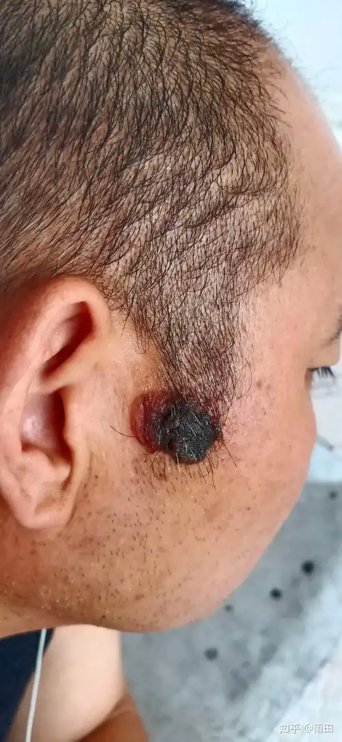 亲身体验冷冻治疗脸部疣猴