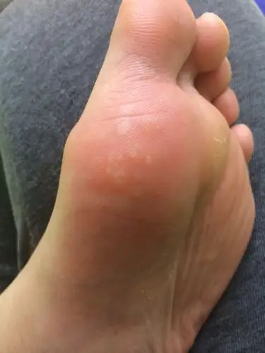 脚底之前出现一两个小白包现在有增多趋势用手按压会有疼痛感但是