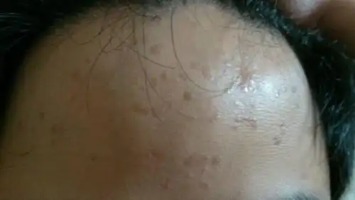 皮肤上长小颗粒,不痛不痒,请问这是什么?会传染吗?有办法去掉吗?