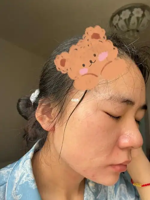 每天记录一下后置皮肤状态第十二天